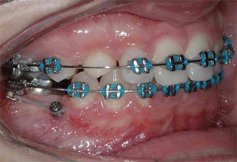 Kotevn implantt