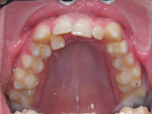 Samoligovac fixn aparty