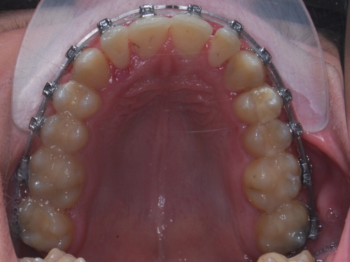 Samoligovac fixn aparty