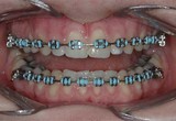 Metal brackets with color elastics