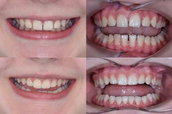 Vsledky lby - pacient 1