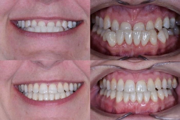 Vsledky lby - pacient 3