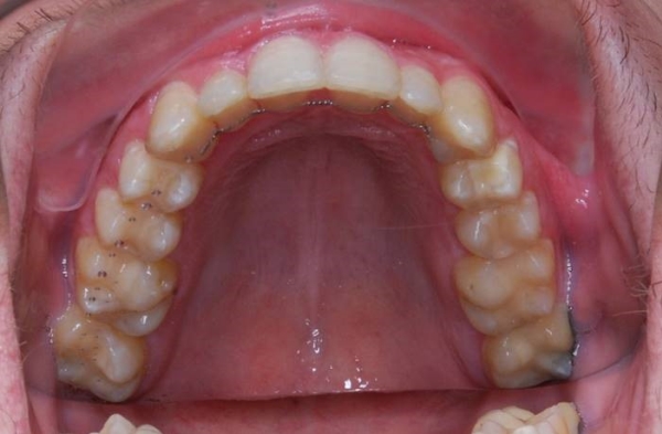 Samoligovac fixn aparty