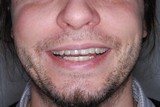 Rovntka invisalign v stech