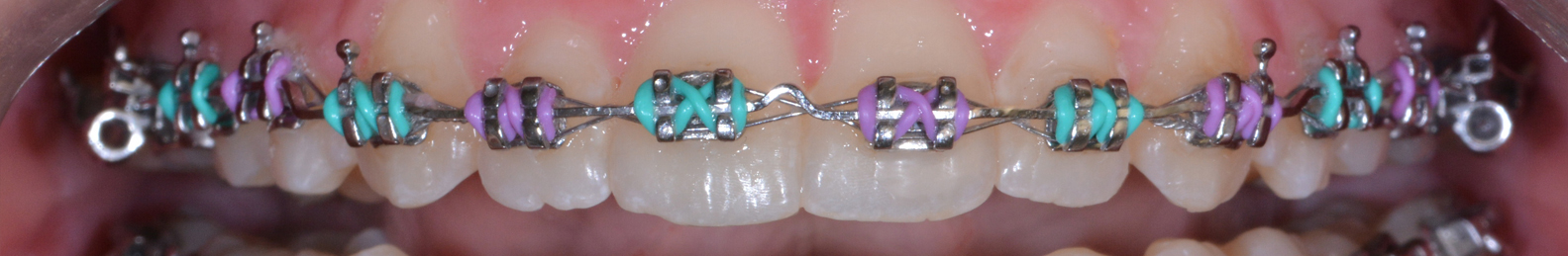 Metal brackets with color elastics