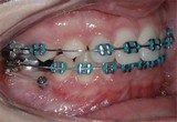 kotevn implantt